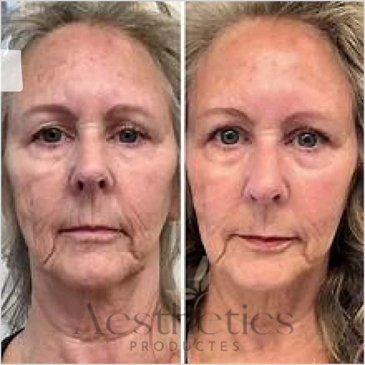 Hyaluronic acid skin booster